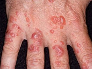 Дерматит — причины, симптомы и лечение дерматита